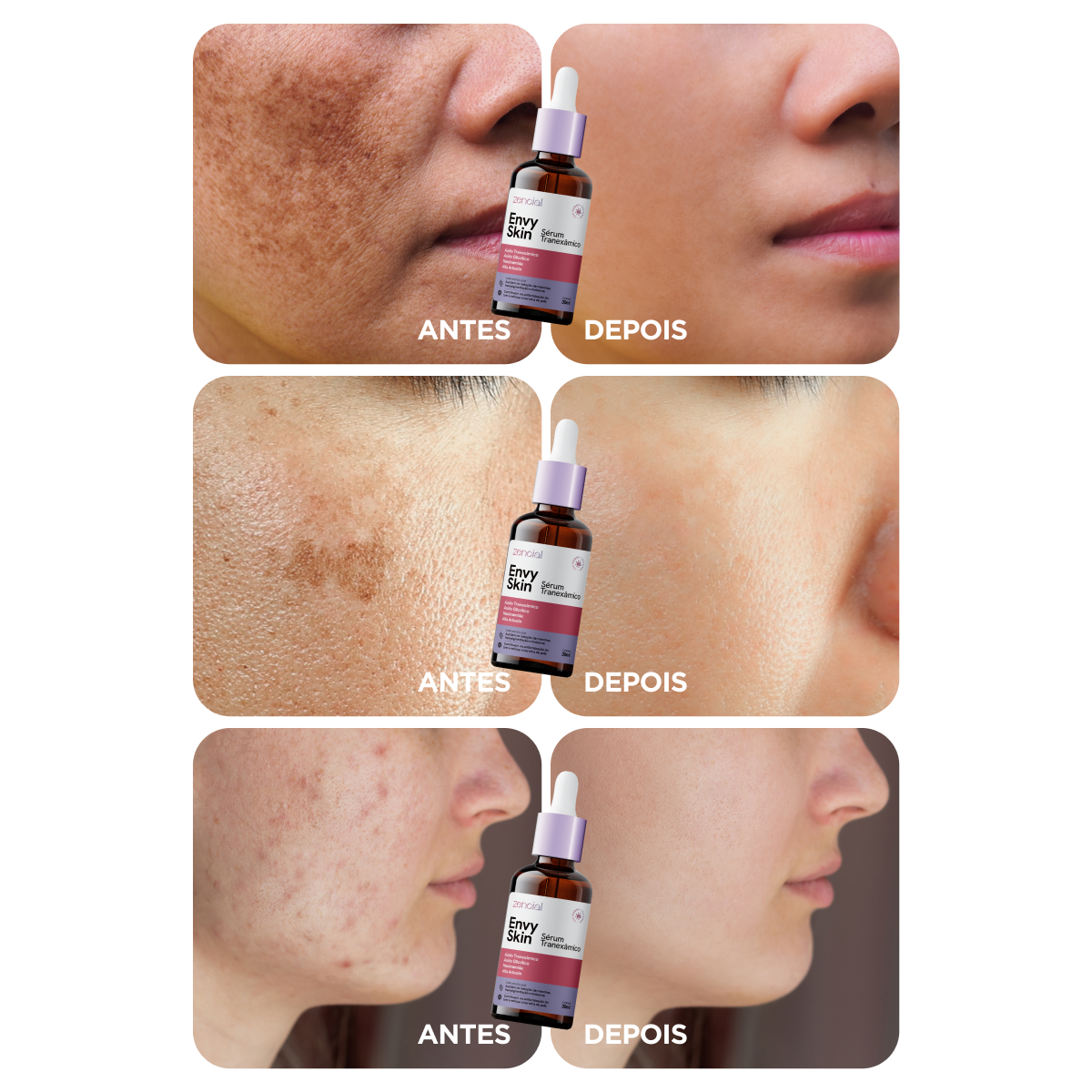 Sérum Clareador Anti-manchas Envy Skin Ácido Tranexâmico
